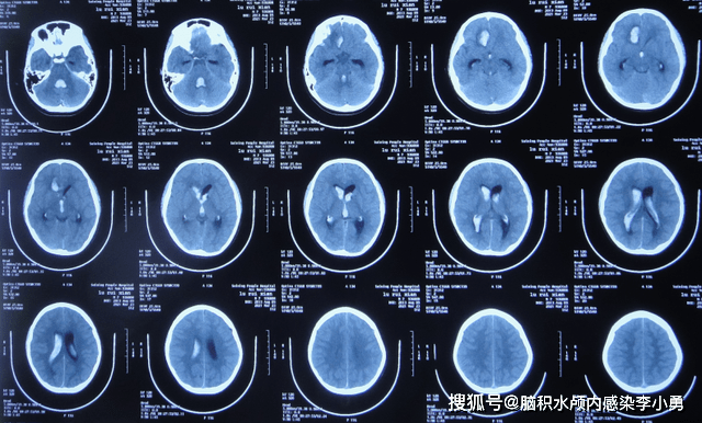 大池|7岁儿童脑出血后脑积水，腰大池引流术后加重感染，顽固性持续发热30余天