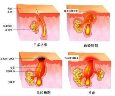 长痘痘这些祛痘误区，你有没有踩雷？为什么长痘？怎么避免长痘？