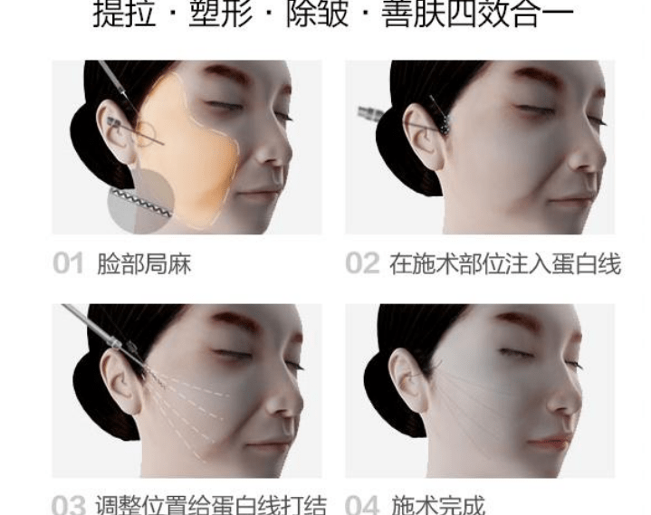 什么ppdo线雕维持时间？ppdo线雕是什么线？怎么抵挡岁月侵染~