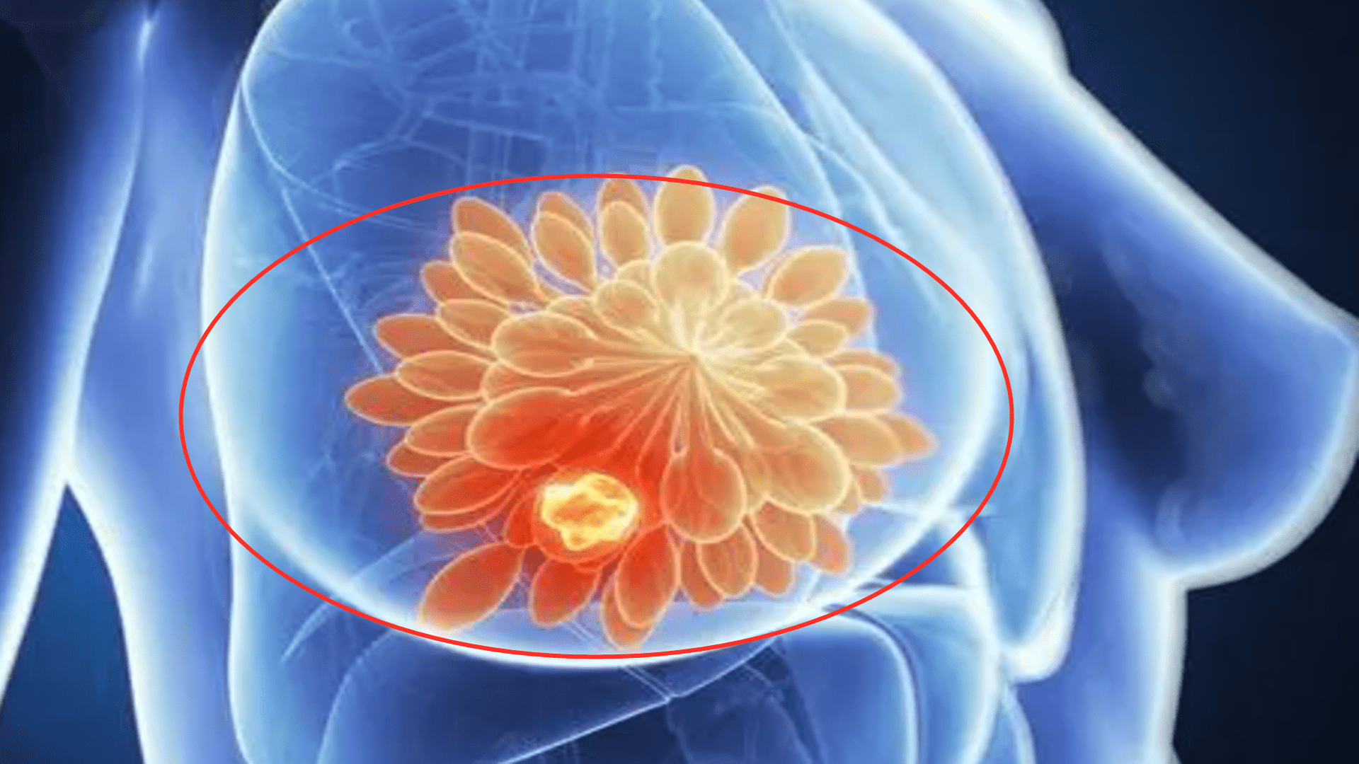 关爱|早期乳腺癌能自查，不要拖到中晚期，但80%的人错过了最佳时间