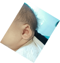 先天性新生儿耳廓畸形一定要重视