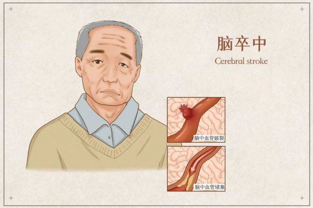 控制|正糖名家：健康的头号“炸弹”，糖尿病患者占1/5，发病风险高，糖友们要重视