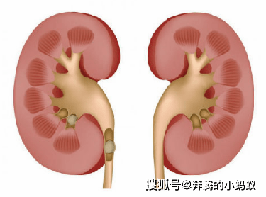 肾脏|体检发现肾囊肿?不要怕,推荐三个治疗方法