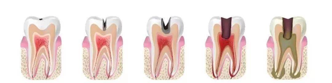 牙齿发黑？牙齿变白？到底哪一种才是蛀牙前身？