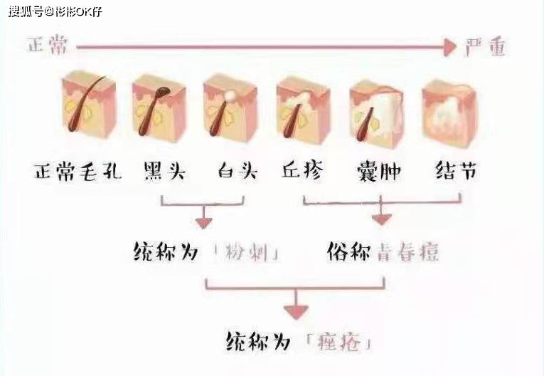 丘疹明星离开精修也一般？明星与普通人颜值最大区别是五官还是皮肤？