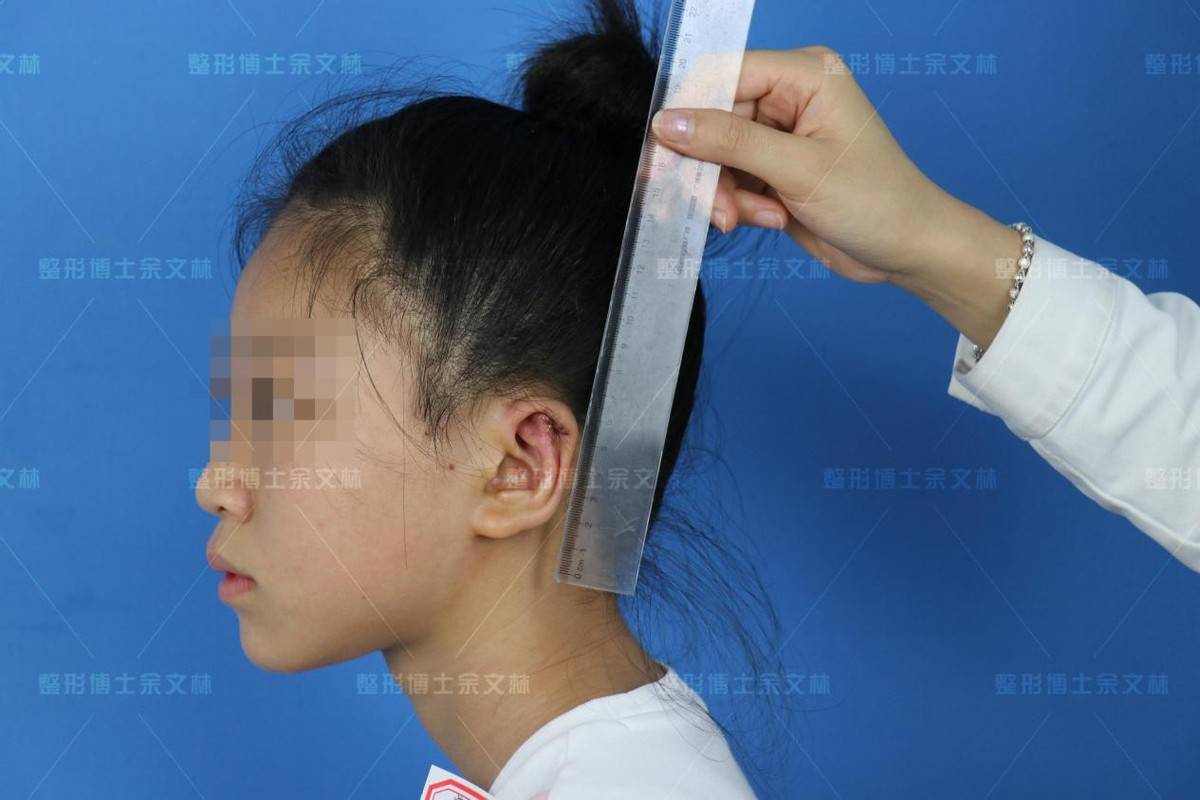 案例分析杯状耳影响学习生活单侧中度杯状耳女孩做手术矫正