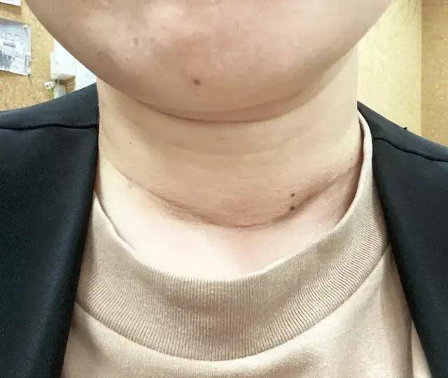 甲友心声甲状腺癌其实没有你想的那么可怕