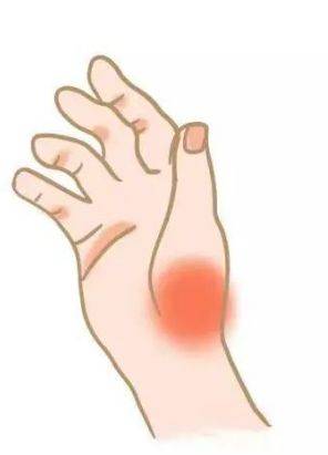 手上突然有一个凸起的包不要慌那是腱鞘包腱鞘炎