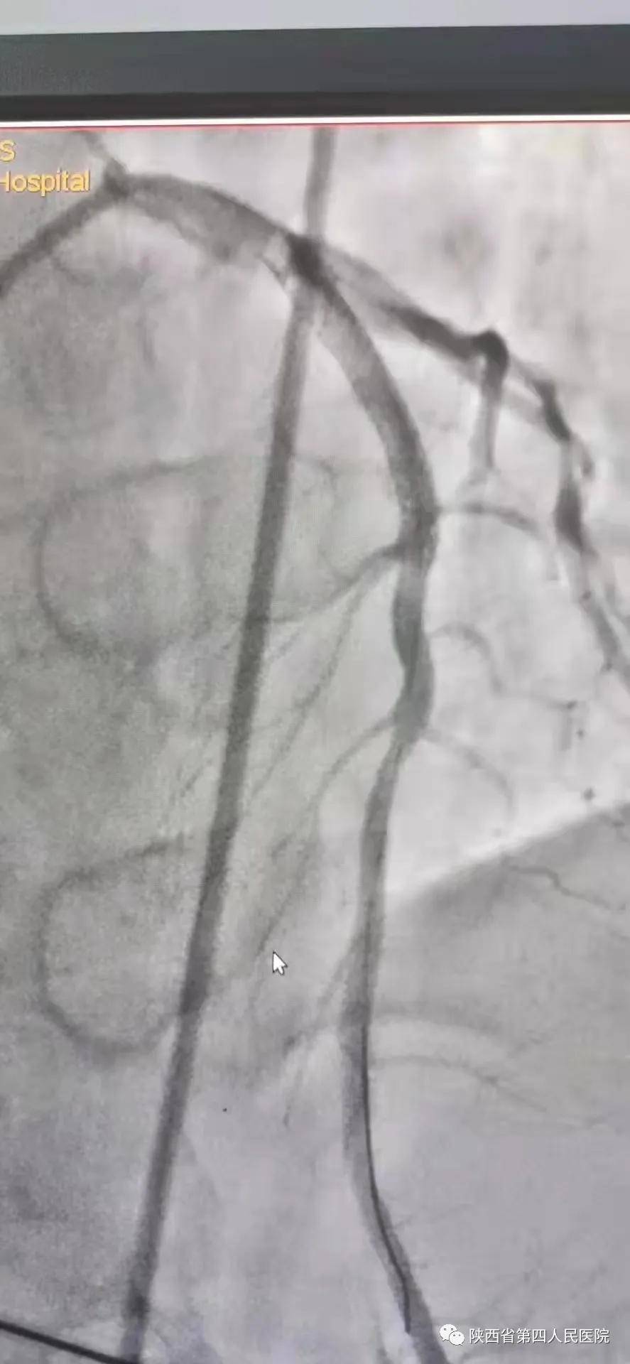 成功|心梗救治，分秒必争--陕西省第四人民医院心内科成功抢救一名急性心肌梗死患者