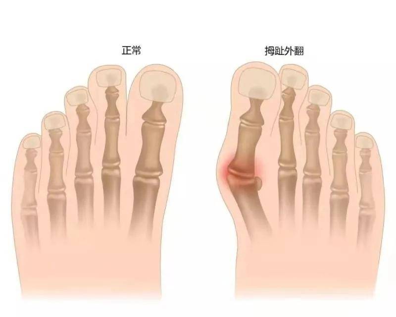 问题|拇外翻手术的确会改变拇趾的长短度吗 马文足科解释