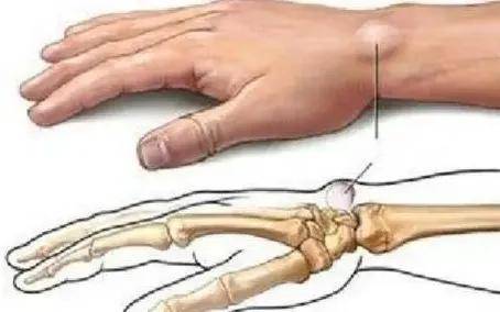 结缔组织|超声科普｜手腕部鼓个包，可咋办呢？