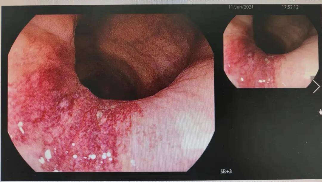 大便|微创治疗｜内痔出血也“要命”