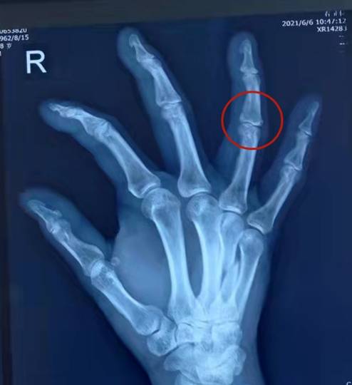 梁雪梅|济南梁氏骨科医院：男子“酒架”受伤后在梁氏骨科“挨整”