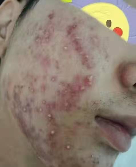 方法痘痘千万别乱挤，找对方法，祛痘很简单的