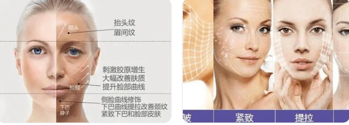 蛋白线雕恢复期真实图片告诉你线雕后脸上有凹陷多久能好？