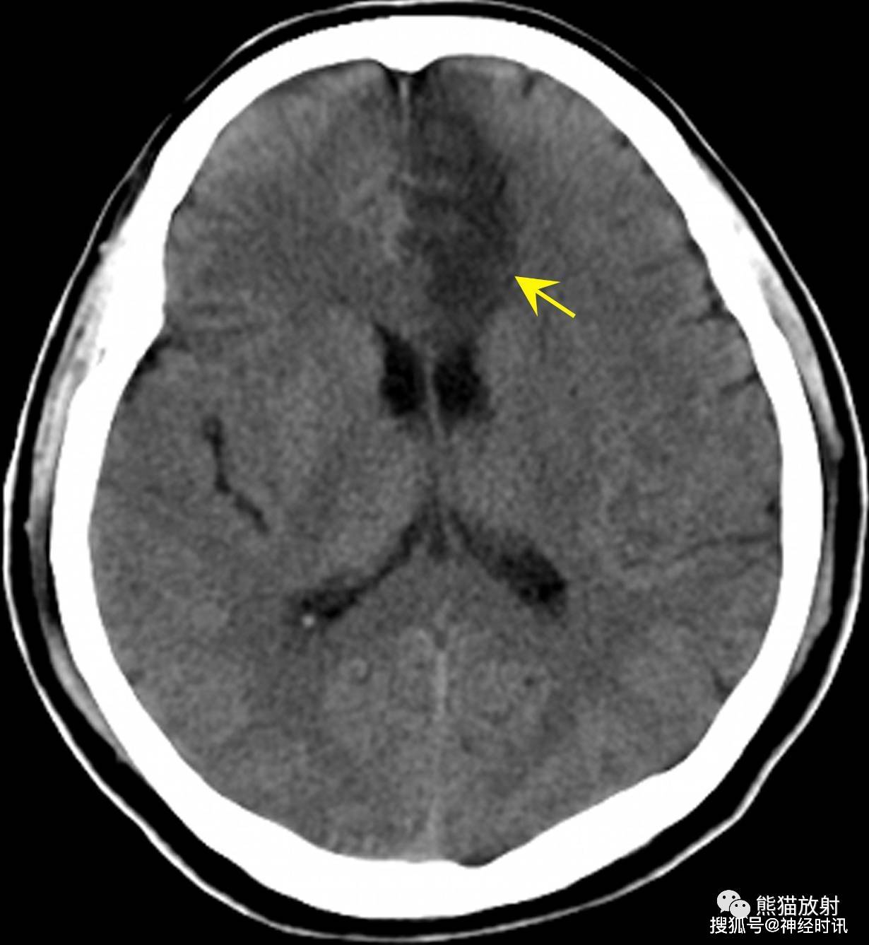 出血性腦梗死橋腦梗死右側放射冠區腦梗死左側額,顳葉,基底節區大片腦