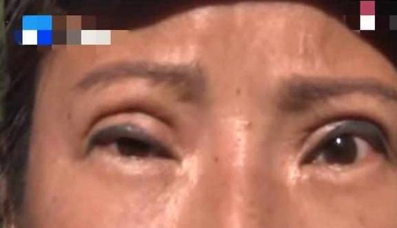 眼睛做完眼部抽脂，右眼睁不开，女子曝光，美容院：我啥都不知道