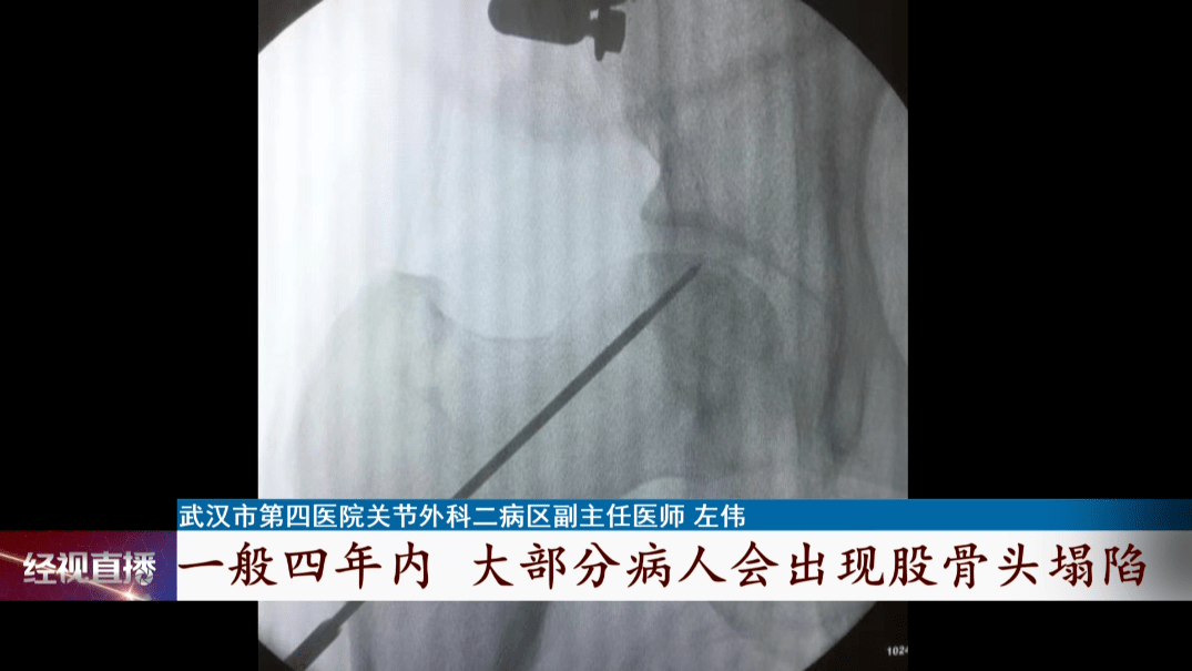 股骨头|27岁小伙长期喝它，股骨头竟成黑色！很多人都爱喝