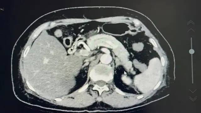 肾上腺|益阳市中心医院成功实施全市首例肾上腺静脉采血