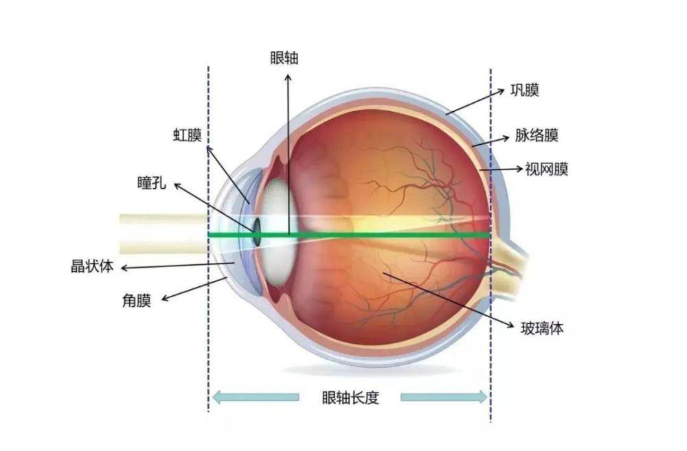 加延華 | 眼軸是什麼,為什麼說眼軸長度與近視有關?