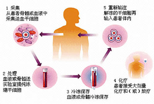 病房|济南血液病医院专家解答：骨髓瘤自体移植是越早移植越好吗