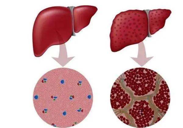 肝脏|4个信号一出现，说明你的肝脏已经开始硬化！