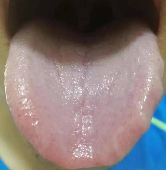 舌头裂口子是怎么回事?