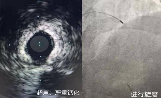 冠脉|冠脉内旋磨｜拿起“金刚钻”降服钙化保健康