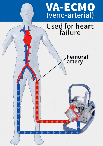 广州女孩感冒2天后心脏停跳6天这种死亡率75的假感冒有多可怕