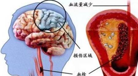 症状|脑中风偏瘫好久了,还有可能治好吗?