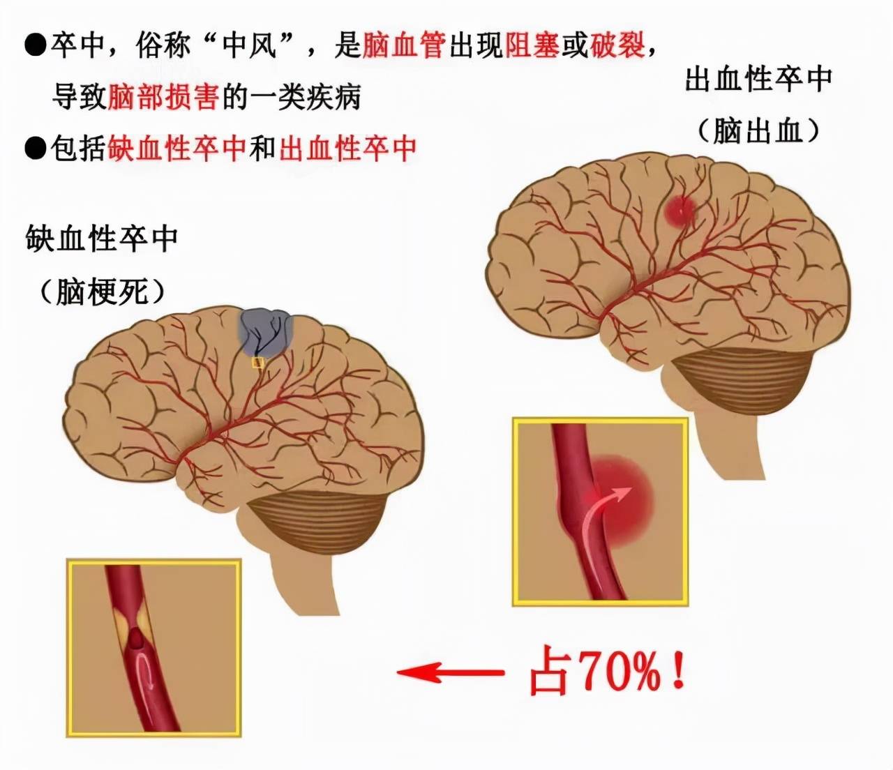 高血壓控制不好對血管傷害大腦卒中早晚找上門這4個