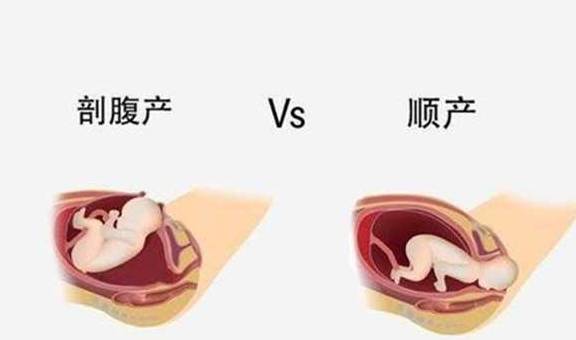 子宫|头胎剖腹产，二胎能选择顺产吗？听听专家怎么说