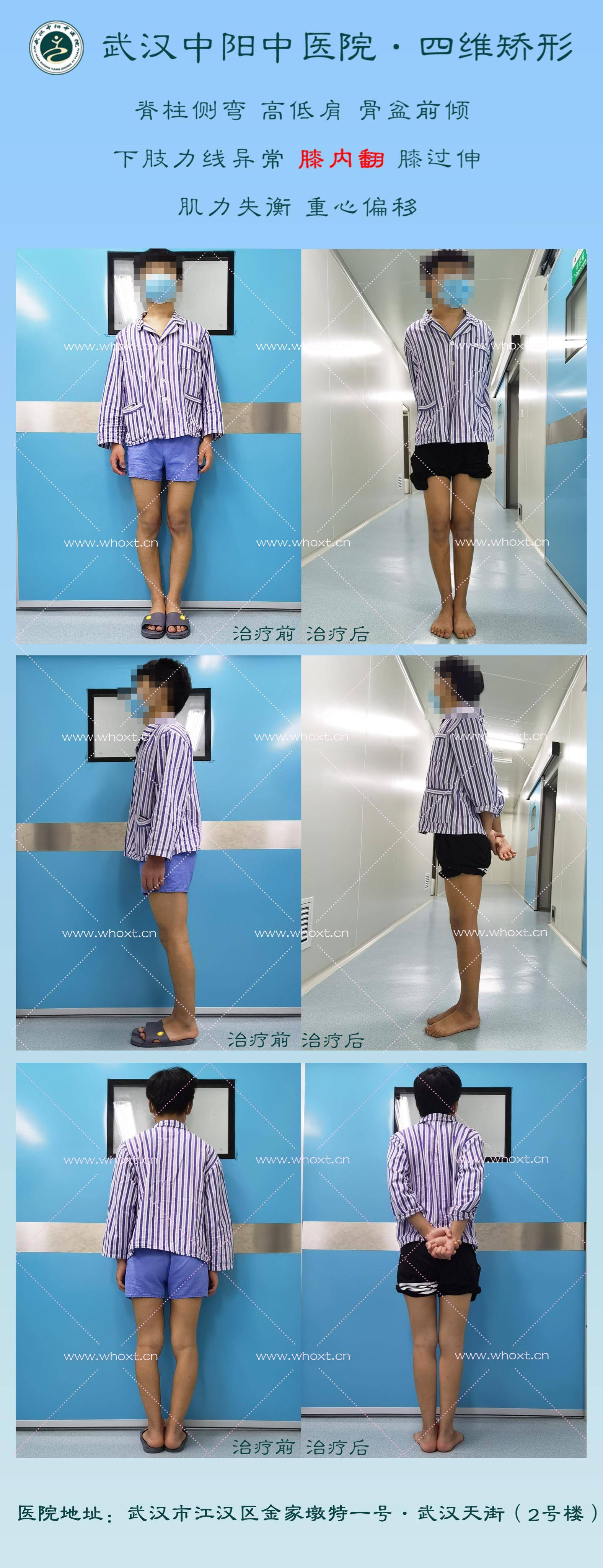 武汉中阳中医院四维矫形微创矫正腿型异常