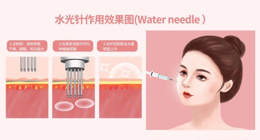 冬季适合做哪些补水项目?水光补水来帮你!