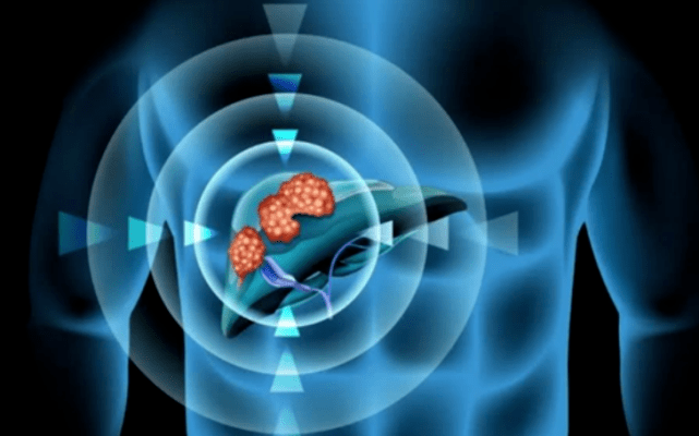 陈建|肝内有癌，腹部先知！不论男女，腹部出现3异常，多半是肝“扛不住了”