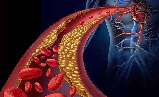 人群|常吃3种低质量早餐,比不吃早餐还要伤血管,很多人天天都在吃