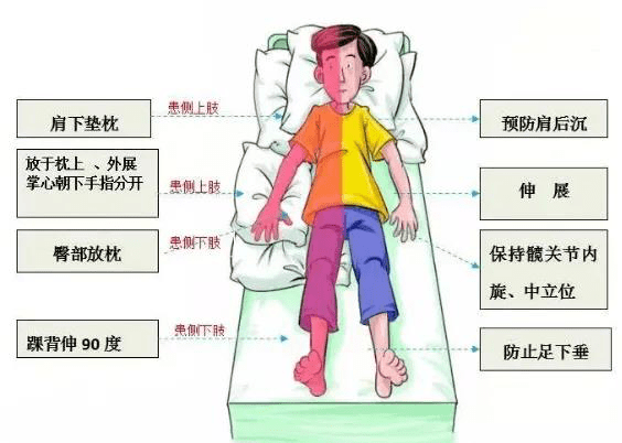 图解脑卒中患者康复训练法这样做好的快在家也能轻松完成