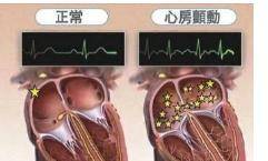 心脏|陈大爷心慌一个月，没有重视，结果中风偏瘫半身不遂！为什么？