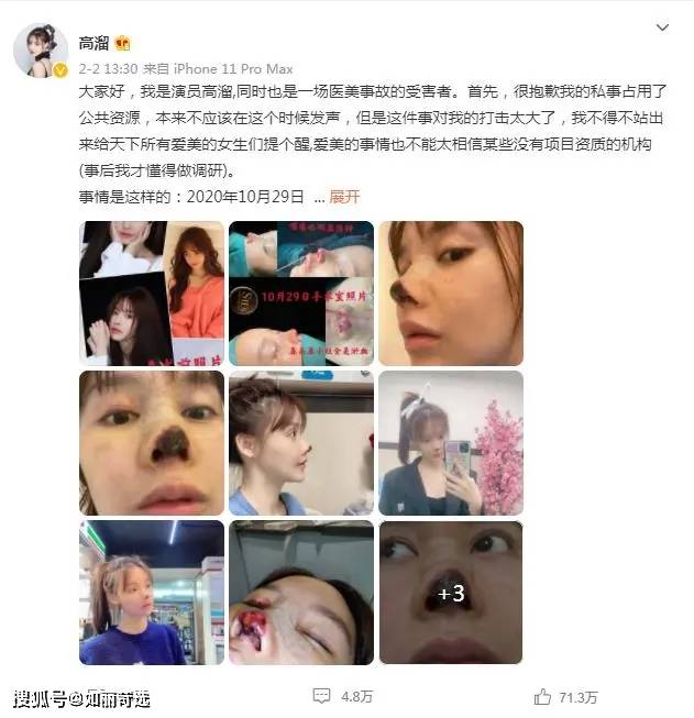 整形女演员自曝隆鼻失败！隆鼻这条路，如何有效的避坑?