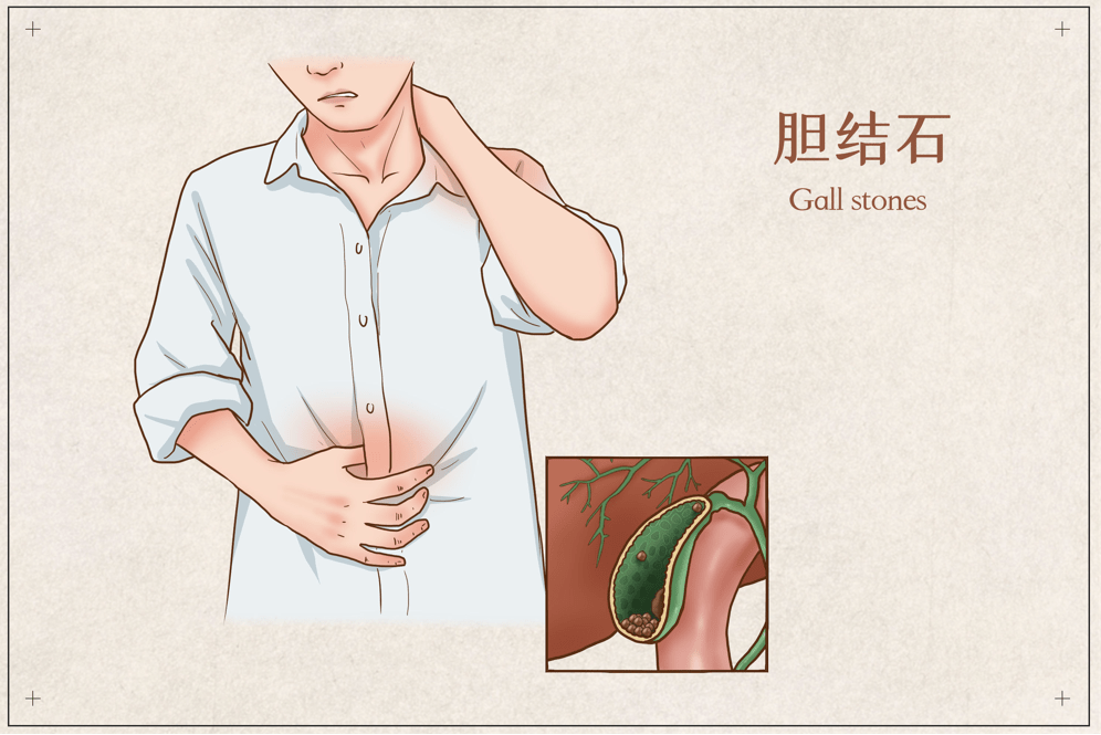 后会|胆囊结石需要手术治疗吗？