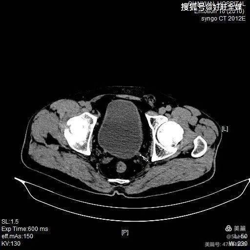 ct平掃-胸主動脈夾層動脈瘤ct引導下穿刺活檢踝關節x線攝影-左側腓骨