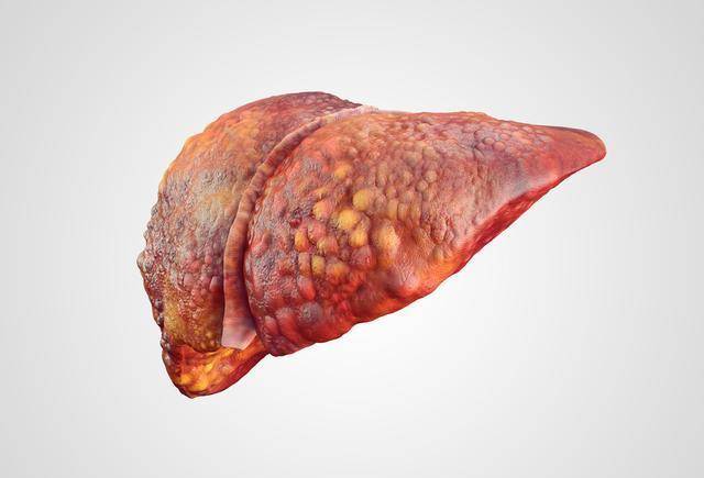 症状|得了肝硬化,究竟还能活多久?做好这几件事,或许还能扭转病情