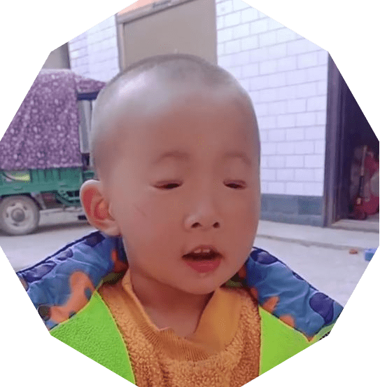 手术|五年八部曲，上睑下垂分阶段治疗的故事