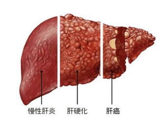 治疗|肝脏“天然解毒王”公布，每天吃两口，排出肝毒，肝硬化不攻自破