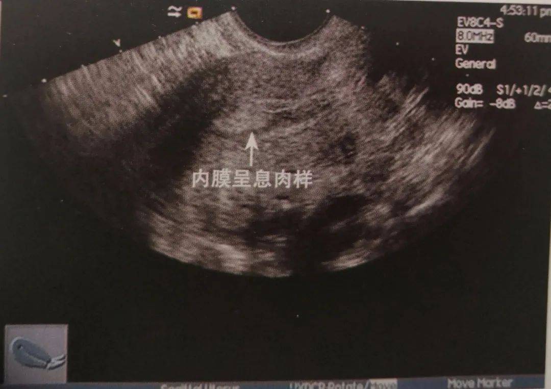 子宫息肉B超图片