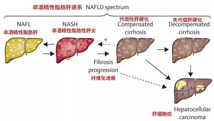 高脂肪|体检发现脂肪肝，该如何处理呢？