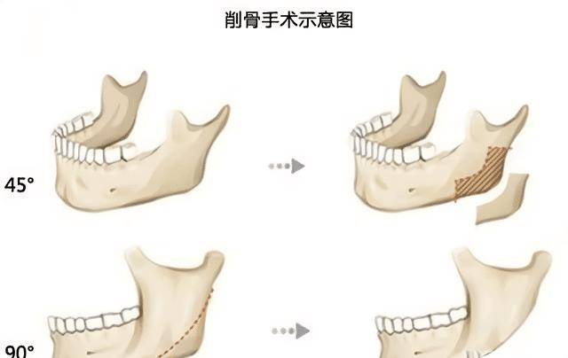 变化那些削骨“一刀切”的明星还好吗？有的已垮掉，小方脸成最后赢家