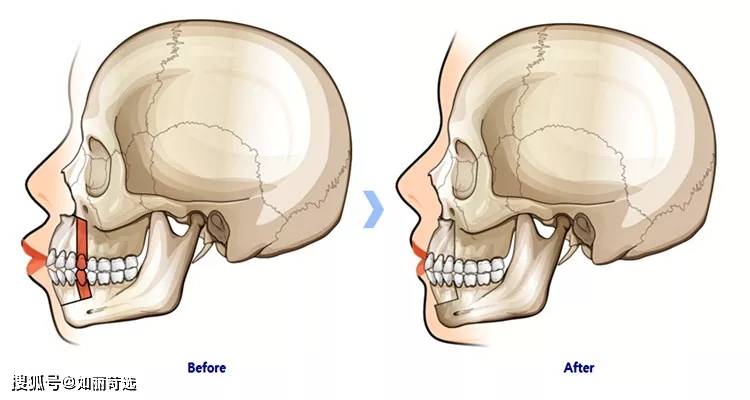 宋轶凸嘴无法修复的四种迹象，千万别中招