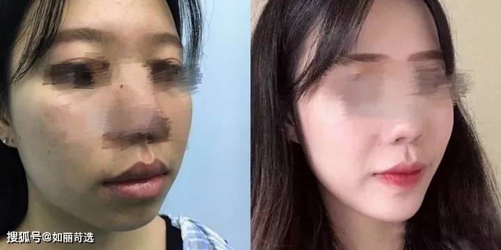 宋轶凸嘴无法修复的四种迹象,千万别中招