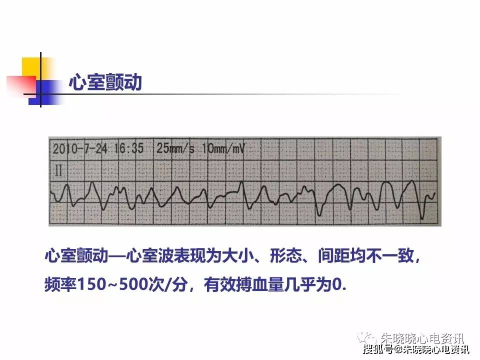 危急值心电图分析(ppt)_心电图_分析
